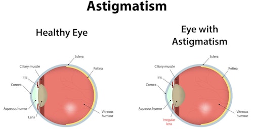 This image highlights the difference between a normal lens on the left, and an eye afflicted with an astigmatism on the right. Photo: www.aoa.org